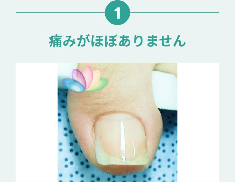 浜松市の女性専門の巻き爪サロンFLATの施術の特徴１：痛みがほぼありません
