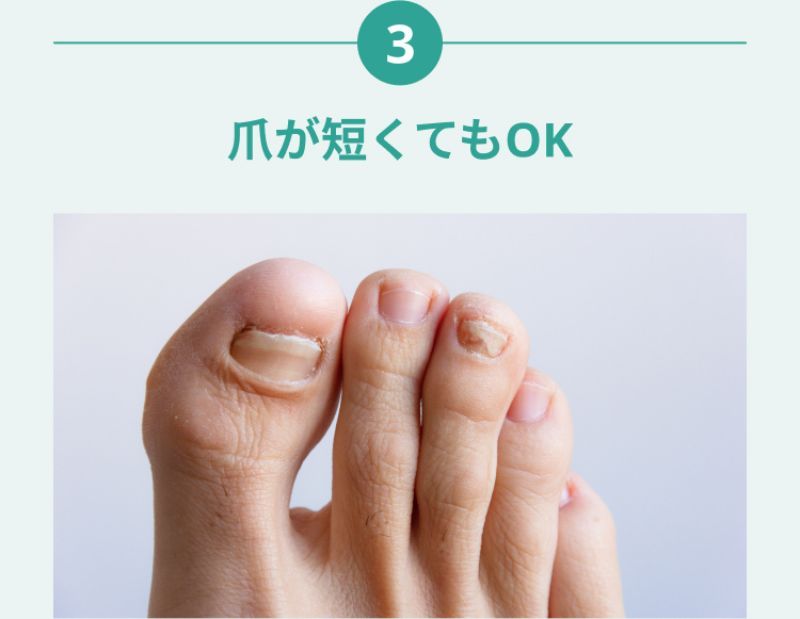 浜松市の女性専門の巻き爪サロンFLATの施術の特徴３：爪が短くてもOK