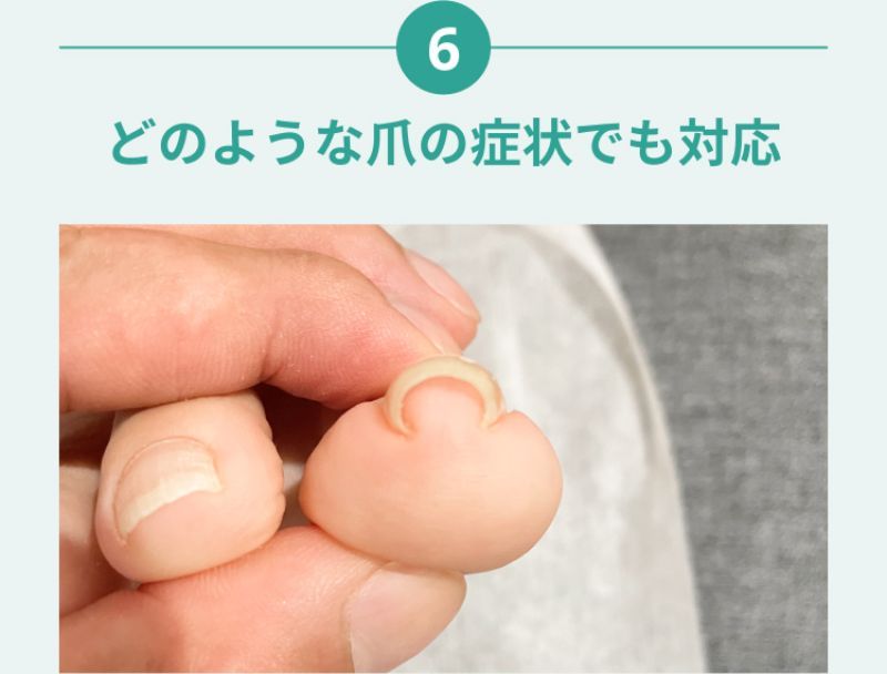 浜松市の女性専門の巻き爪サロンFLATの施術の特徴６：どのような爪の症状でも対応